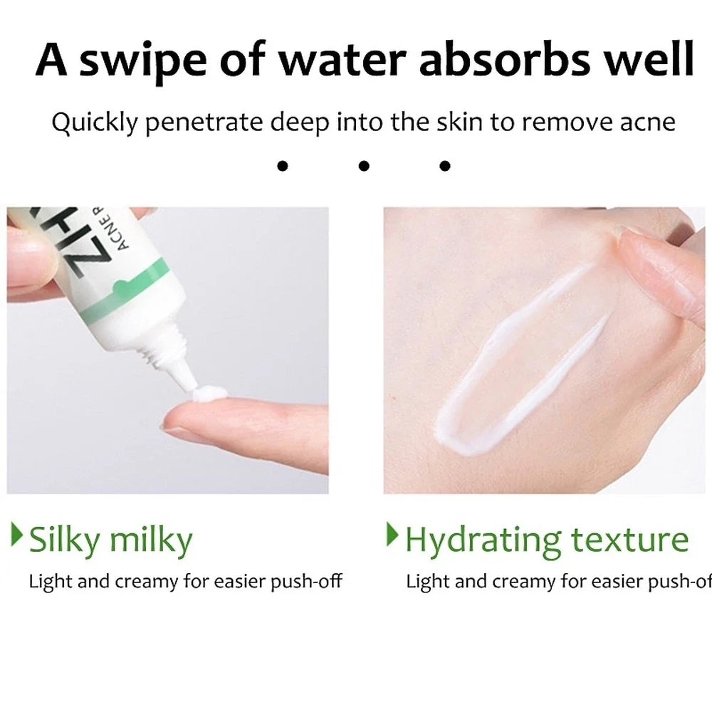 Creme Facial Anti-Acne com Ácido Salicílico para Remover Óleo e Cabeça Preta, Clareador de Cicatrizes