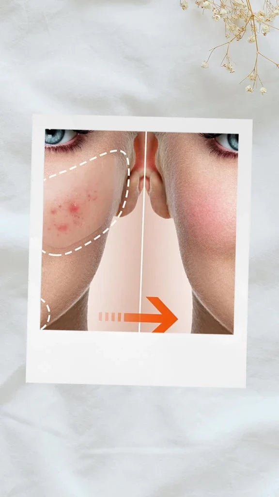 Creme Facial Anti-Acne com Ácido Salicílico para Remover Óleo e Cabeça Preta, Clareador de Cicatrizes